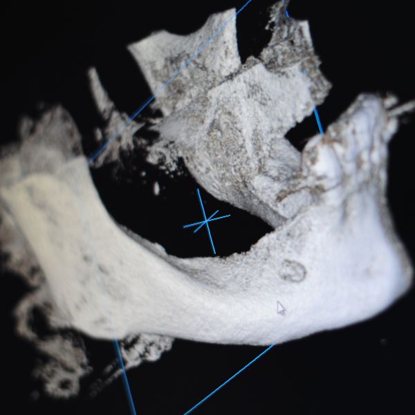 3D-Implantatplanung mit Navigation